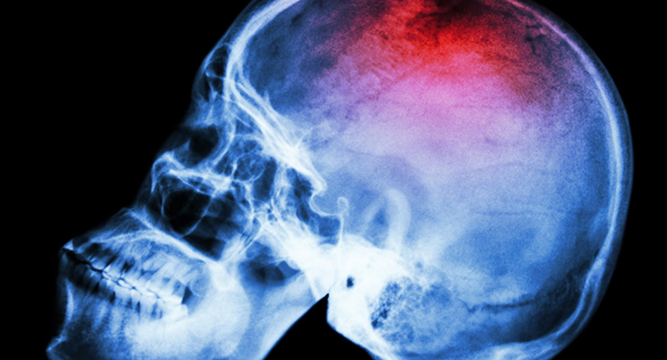 head injuries in playgrounds